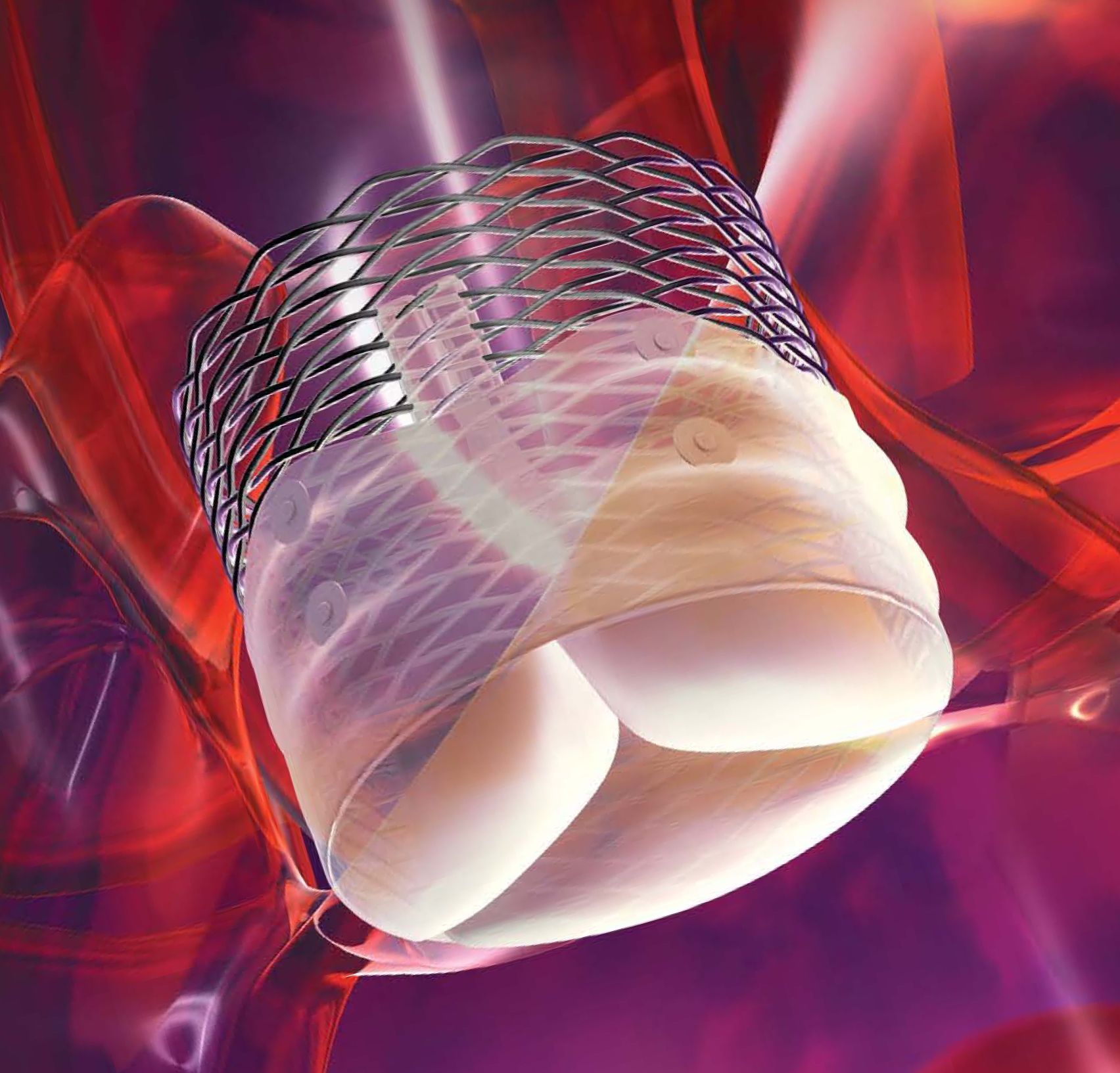 The Lotus Heart Valve from Boston Scientific